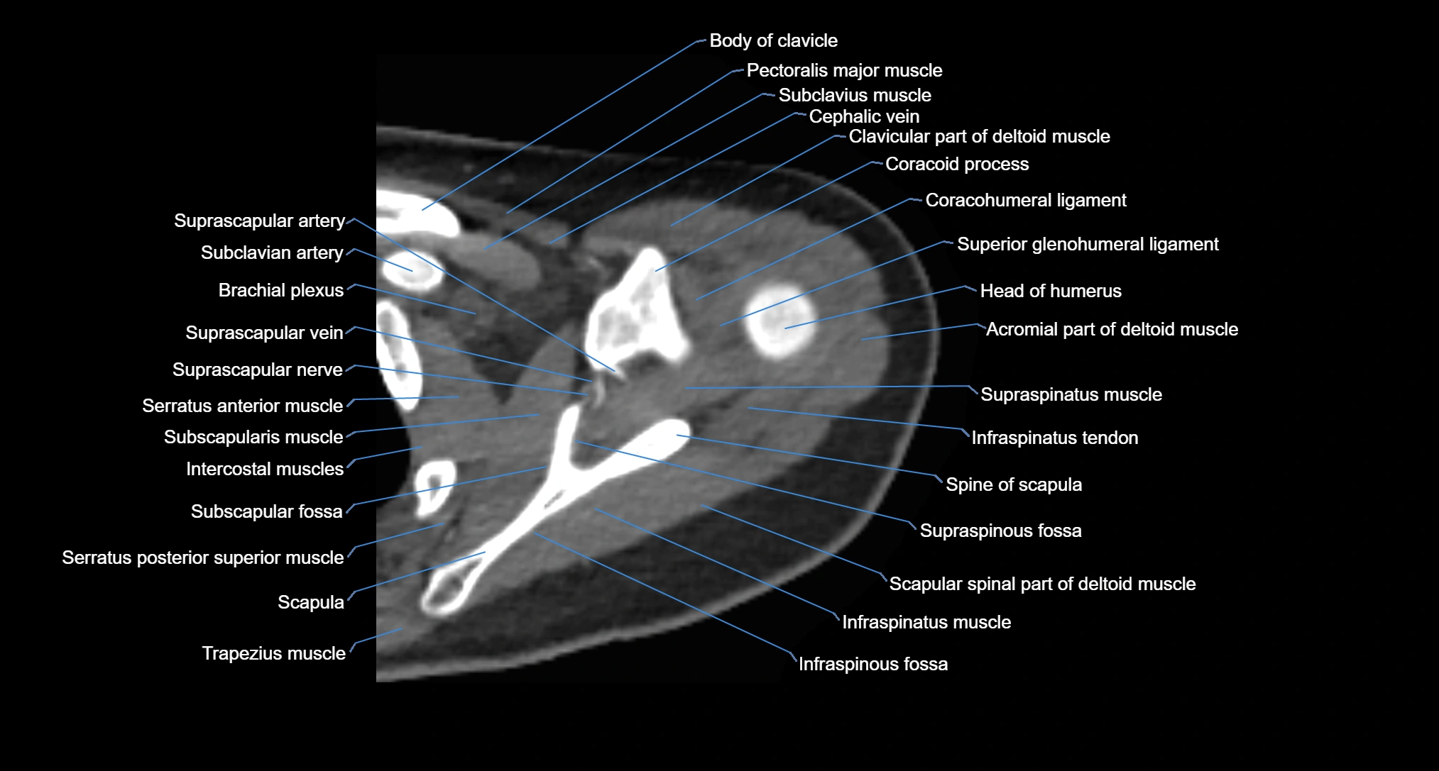 CT Shoulder axial cross sectional anatomy labelled radiology image -00023.webp